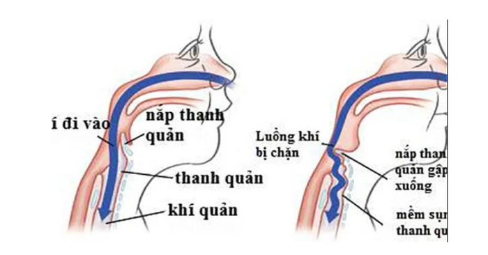 Mô phỏng nguyên nhân gây ra hiện tượng thở rít ở trẻ