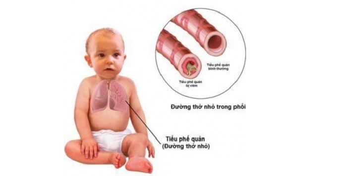 Bệnh viêm phế quản thường gặp ở trẻ dưới 2 tuổi