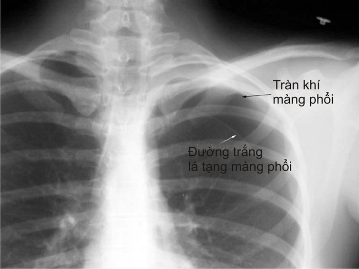 Hình ảnh chụp X-quang về tràn khí màng phổi