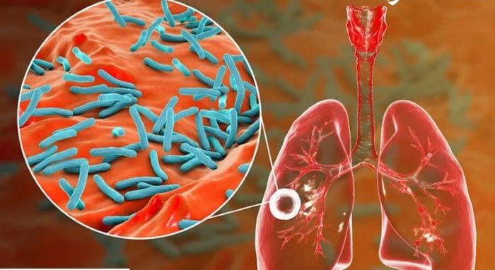 M.Tuberculosis có khả năng xâm nhập, trú ngụ, sinh sôi tại phổi và gây bệnh lao