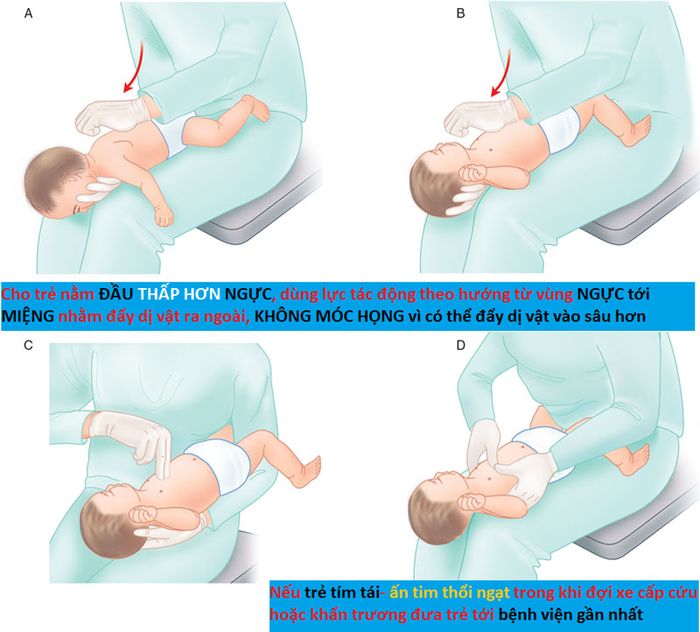 Các bước xử lý dị vật đường thở với trẻ nhỏ