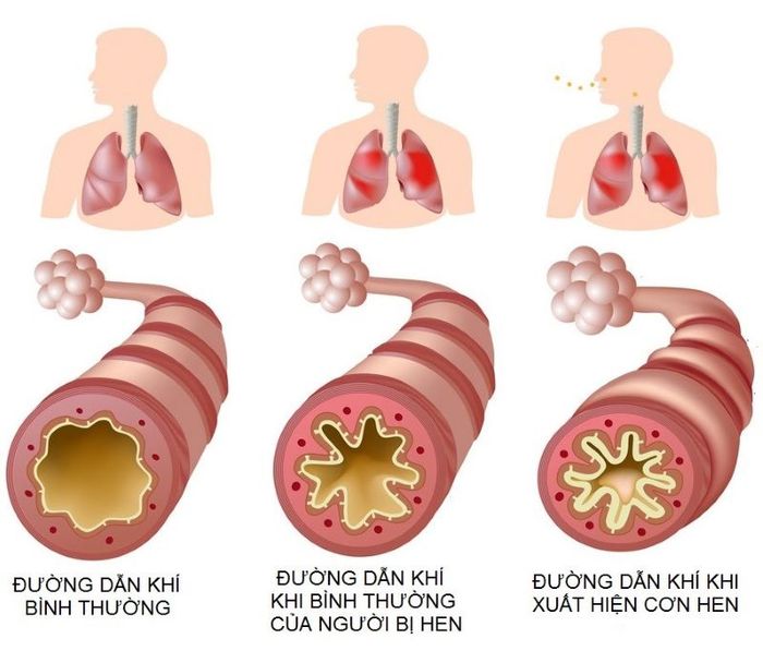 Khi lên cơn hen, đường dẫn khí qua phế quản bị hạn chế do thu hẹp đường dẫn