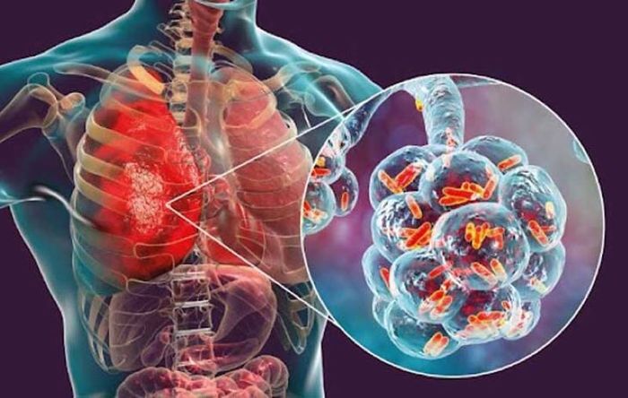 Bệnh viêm phổi do vi khuẩn phế cầu có thể gây tử vong ở trẻ em và người già