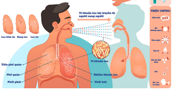 Con Đường Lây Nhiễm Lao Và Triệu Chứng Nhận Biết Bệnh Lao Phổi