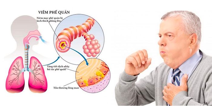 Viêm phế quản cấp tính có thể chuyển thành mạn tính nếu tái phát nhiều lần.
