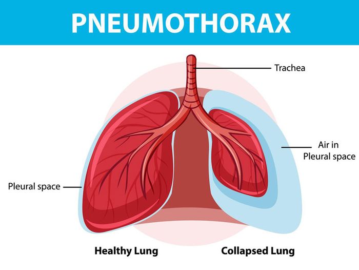 Tràn dịch màng tim có thể làm phế quản bị ép