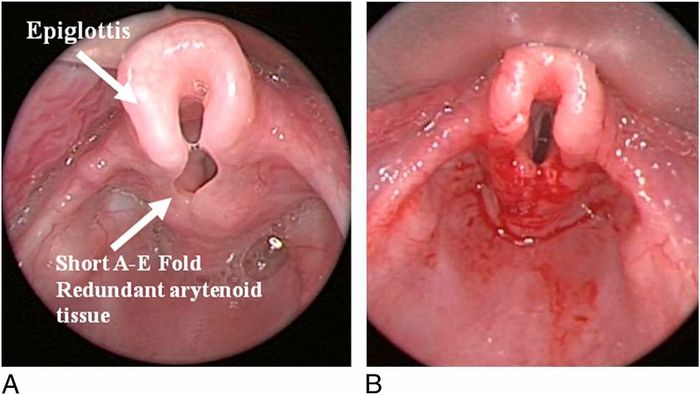 Trẻ thở rít cũng có thể mắc bệnh viêm thanh nhiệt.