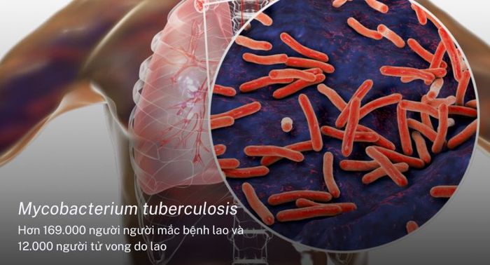 Mycobacterium Tuberculosis là tác nhân gây ra bệnh lao phổi