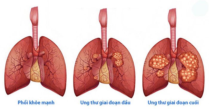 Tiến triển của tổn thương phổi qua từng giai đoạn của bệnh ung thư phổi