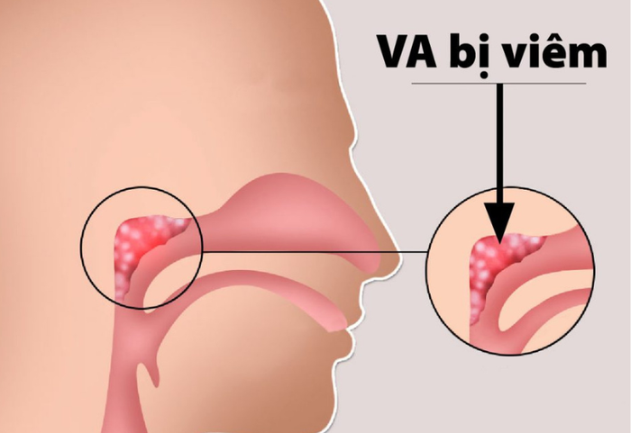 Virus gây cảm lạnh là nguyên nhân chủ yếu của bệnh viêm VA ở trẻ.