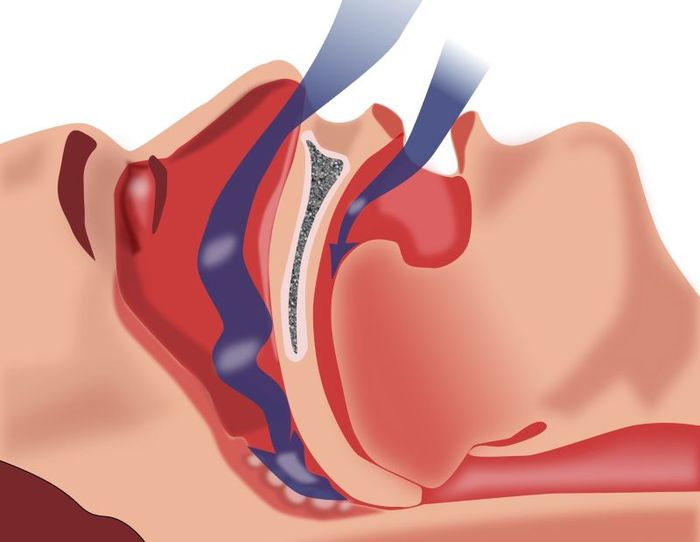 Hội Chứng Ngưng Thở Lúc Ngủ Có Thể Xảy Ra Nhiều Lần Trong Đêm