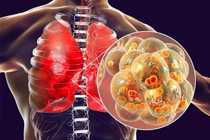 Viêm phổi thường là kết quả của sự xâm nhập của vi khuẩn phế cầu