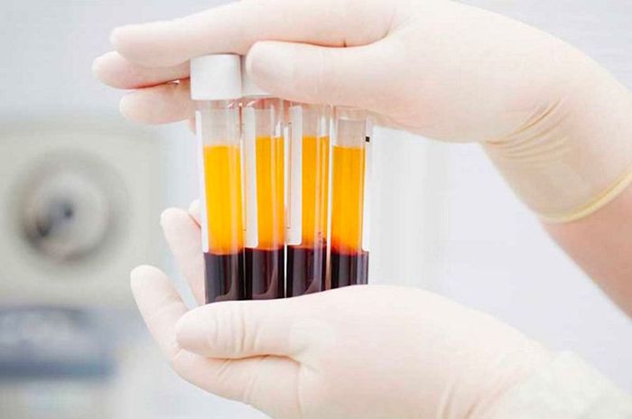 Xét nghiệm máu để phát hiện kháng thể là một phương pháp quan trọng trong chẩn đoán bệnh.
