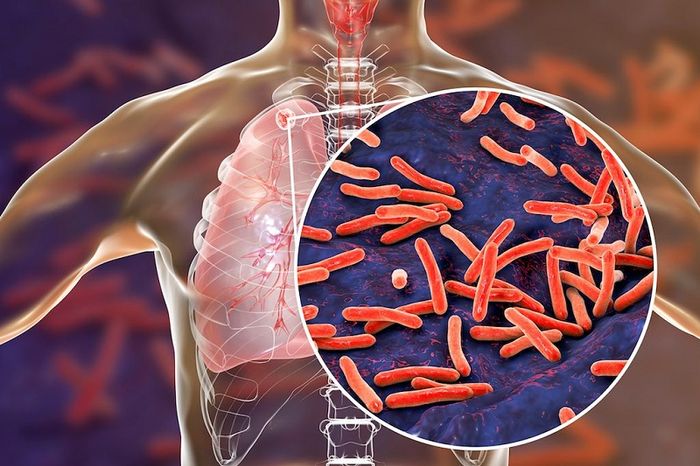 Lao phổi có thể gây ra nhiều biến chứng nguy hiểm