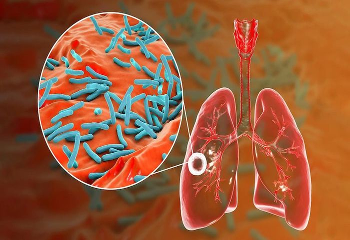 Lao phổi là do vi khuẩn lao thuộc họ Mycobacterium gây ra