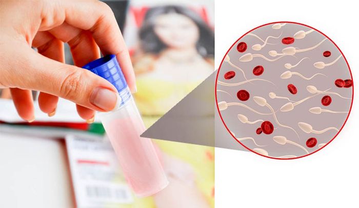 Tinh dịch màu nâu hoặc có chứa máu là dấu hiệu không bình thường trong hệ thống sinh dục nam giới