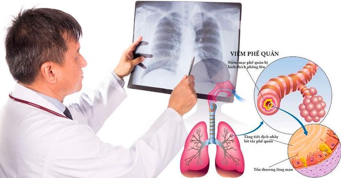 Khái niệm về bệnh viêm phế quản