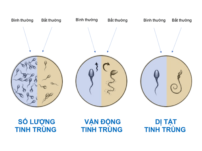 Chất lượng tinh trùng đóng vai trò quan trọng trong vấn đề vô sinh ở nam giới