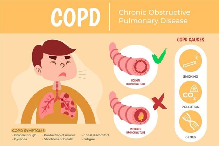 Các nguyên nhân chính dẫn đến bệnh phổi tắc nghẽn mạn tính