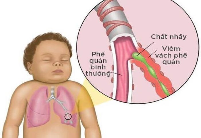 Phế quản bình thường và phế quản ở trẻ mắc bệnh hen suyễn