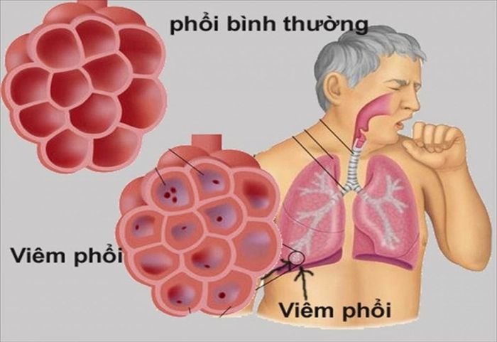 Viêm phổi có thể là một trong những nguyên nhân dẫn đến suy hô hấp
