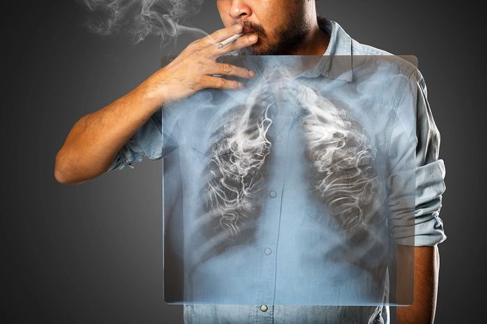 Hút thuốc lá lâu năm là một nhóm rủi ro cho sức khỏe