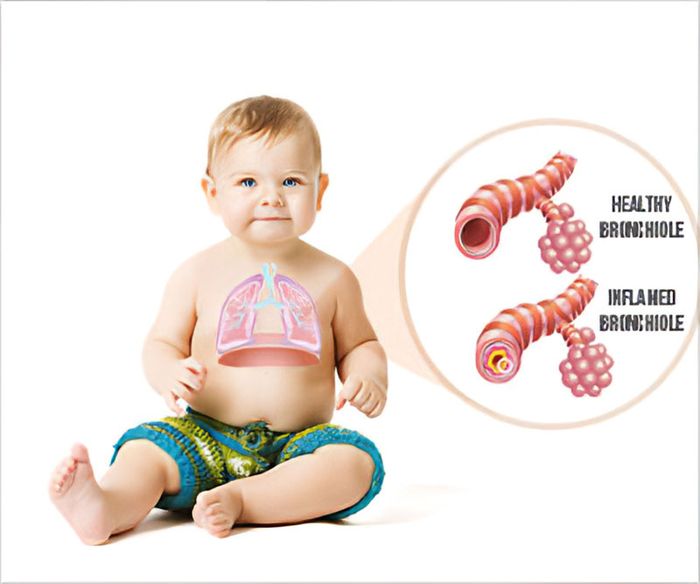 Khái niệm về viêm phế quản co thắt ở trẻ em