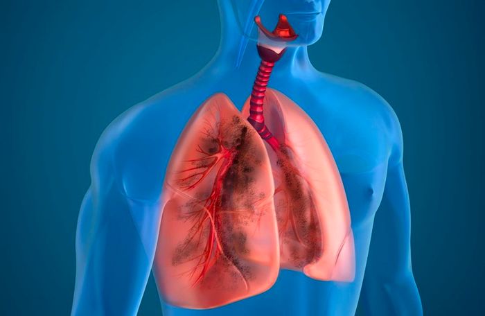Bệnh phổi tắc nghẽn mạn tính là một căn bệnh phổ biến