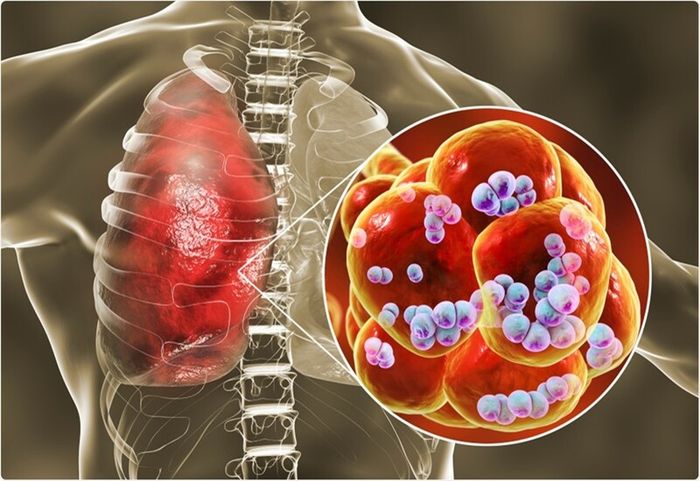 Viêm phổi là một trong những bệnh đường hô hấp dưới phổ biến