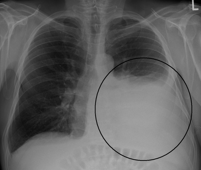 Hiện tượng tràn dịch ở màng phổi gây ra cảm giác khó thở, sốt
