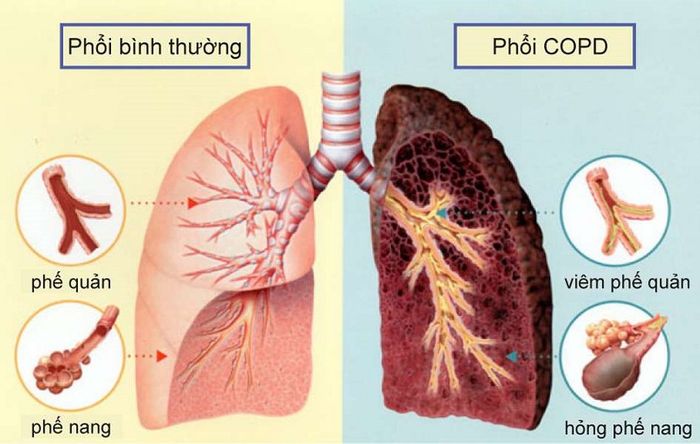 Phổi khỏe mạnh và phổi bị COPD