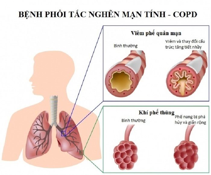 Đôi nét cơ bản về bệnh phổi tắc nghẽn mạn tính