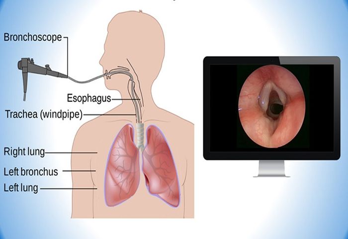Nội soi phổi đóng vai trò quan trọng trong việc chẩn đoán các bệnh liên quan đến đường hô hấp