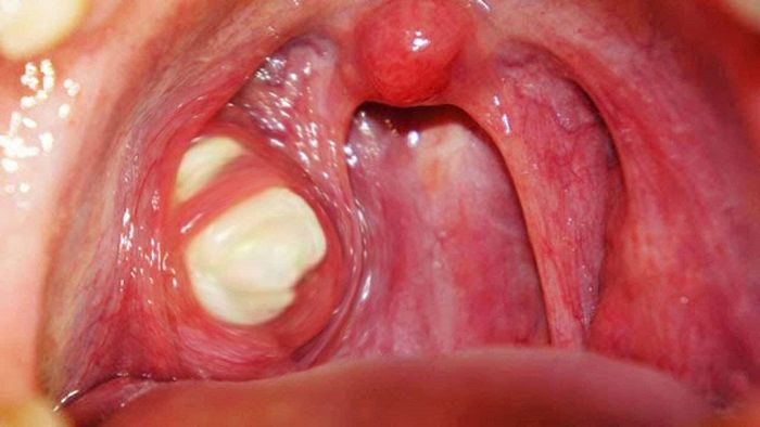 Vòm họng chứa những hạt trắng nhỏ có kích thước giống như hạt đậu.