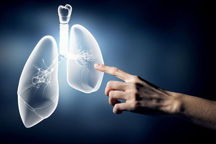 Viêm phổi là một trong những biến chứng nguy hiểm của bệnh xơ phổi.