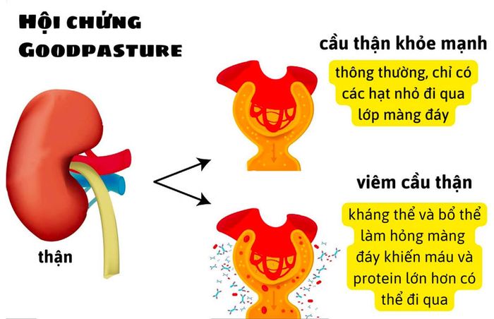 Bệnh thận phế nang xuất huyết là một vấn đề nguy hiểm cho sức khỏe