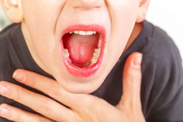 Ngứa họng kéo dài cần phải được điều trị hiệu quả