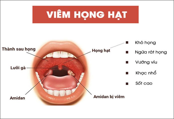 Biểu hiện của bệnh viêm họng hạt có thể gây ra đau họng nhưng không ho