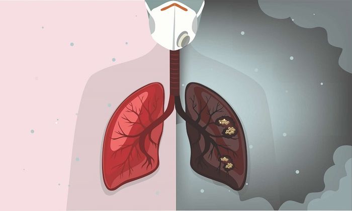 Ho nhiều có thể là biểu hiện của ung thư phổi