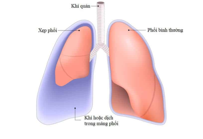 Xẹp phổi có thể gây ra nhiều biến chứng khó lường