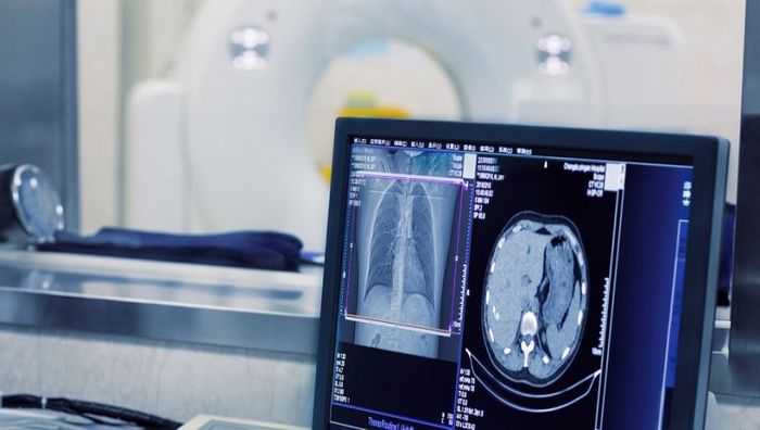 Việc chụp CT phổi đóng vai trò quan trọng trong quá trình chẩn đoán và điều trị ung thư phổi