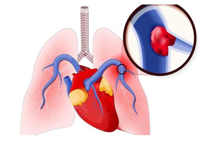 Cục máu đông có thể gây thuyên tắc động mạch phổi