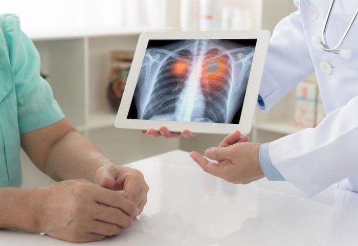 U phổi được phân loại thành hai loại: u phổi lành tính và u phổi ác tính