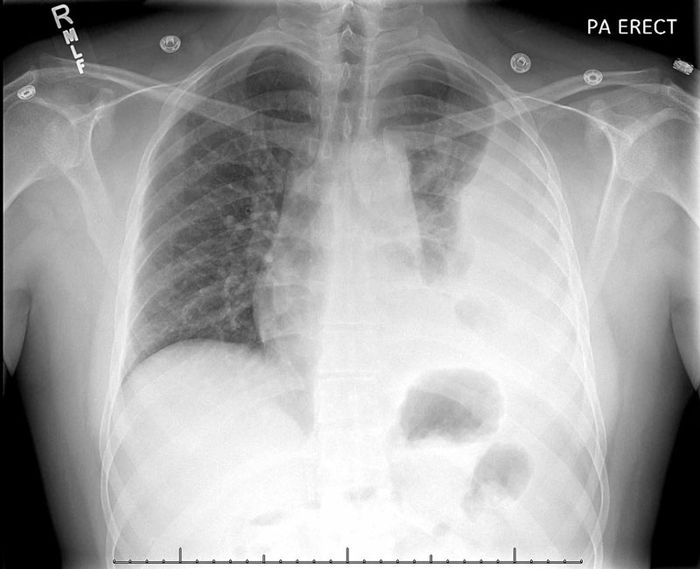 Vi khuẩn tấn công phổi của bệnh nhân gây ra tổn thương nghiêm trọng