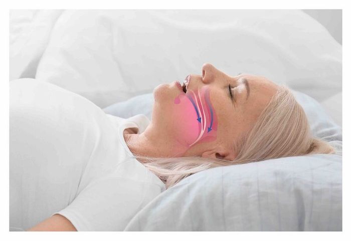 Ngưng thở khi ngủ là một vấn đề về đường hô hấp trong giấc ngủ