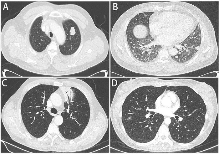 Chụp CT được áp dụng cho những bệnh nhân nghi ngờ có tổn thương sâu ở vùng phổi