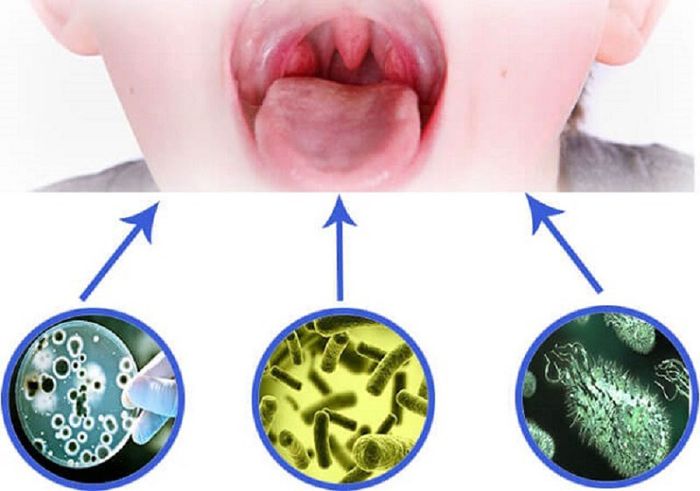 Virus có thể gây ra cảm giác đau khi nuốt nước bọt