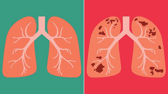Bệnh lao là bệnh nhiễm trùng do vi khuẩn gây ra