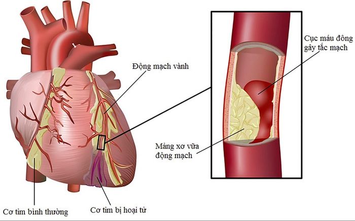 Triệu chứng đau ngực là dấu hiệu của bệnh gì