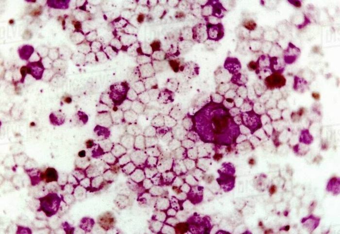 Virus Hợp Bào Hô Hấp - Nguy Hiểm Đối Với Trẻ Sơ Sinh Và Trẻ Yếu Sức Khỏe